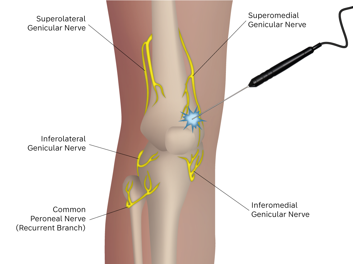Illustration: cryoprobe position at nerve